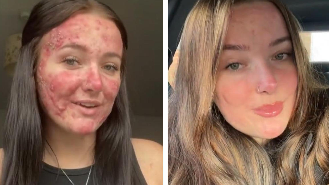 Ora Courtney, 21 anni, è una delle beauty influencer vittima di bullismo a scuola a causa della sua grave acne