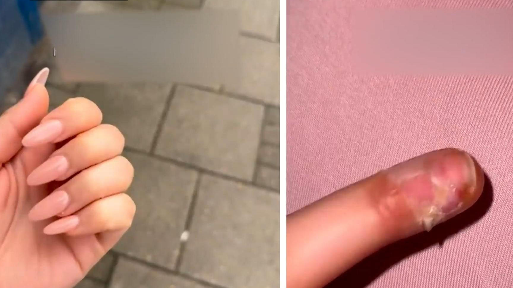 A 21-year-old woman almost lost her finger after a nail procedure, and doctors were considering amputating it