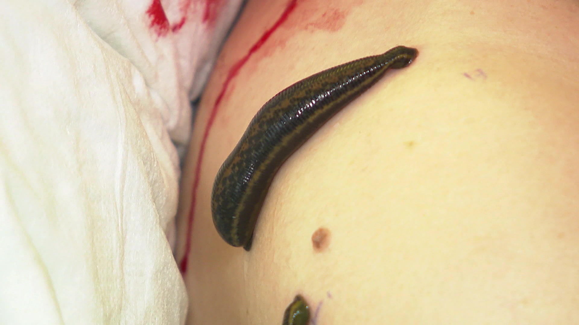 How vampires can help pain patients with leech therapy