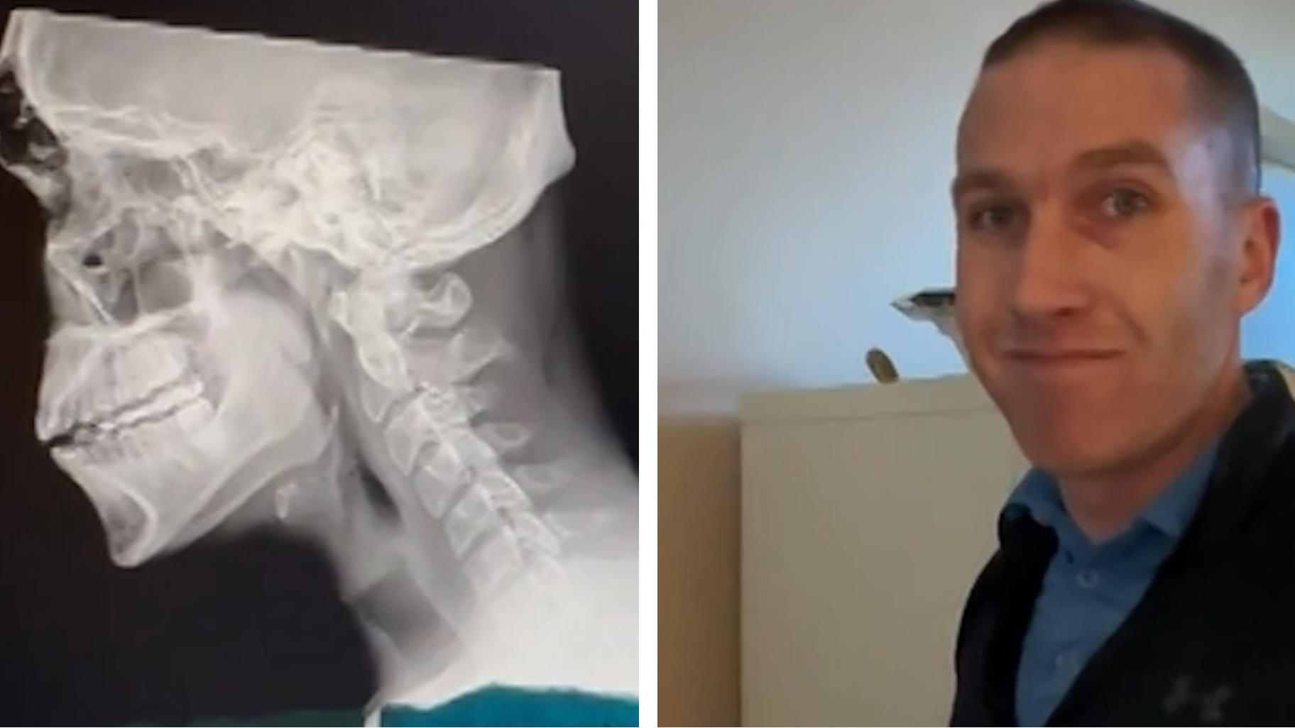 Arzt schockt mit Röntgenbildern Immer mehr Buckel